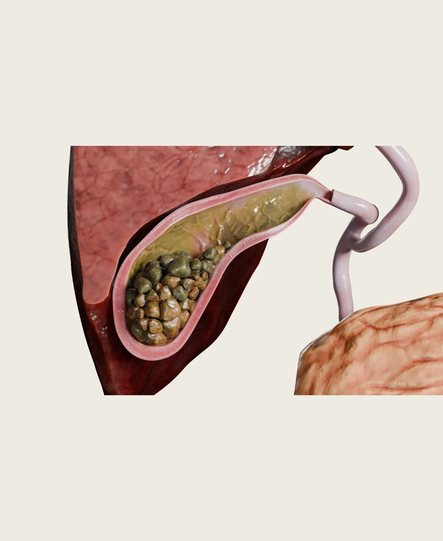 Dr. Neel Patel - Gallbladder & Biliary care at Niraaya Hospital Gandhinagar